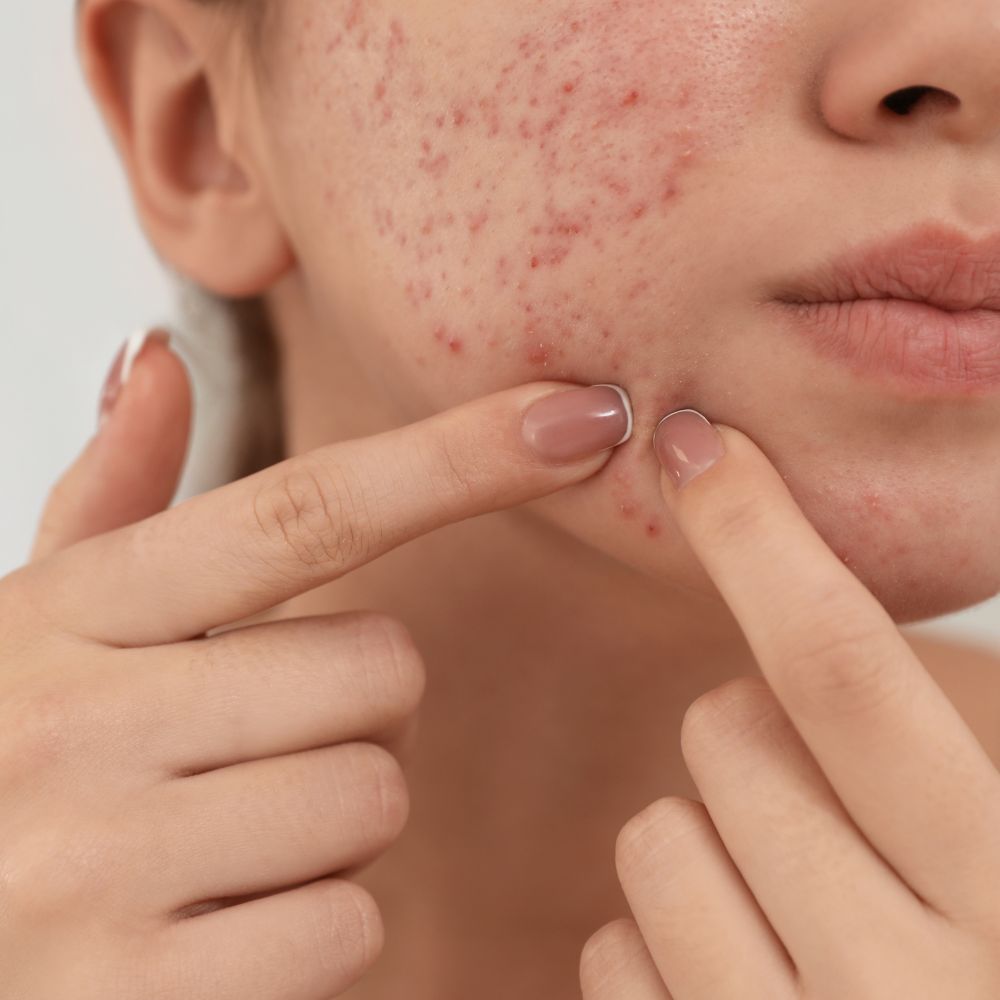 Laser Acne Treatment – Sarasota