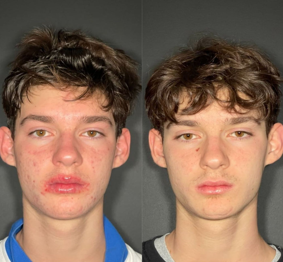 Teenage male patient before and after Aerolase laser treatment in Sarasota, showing dramatic reduction in acne breakouts and scarring.