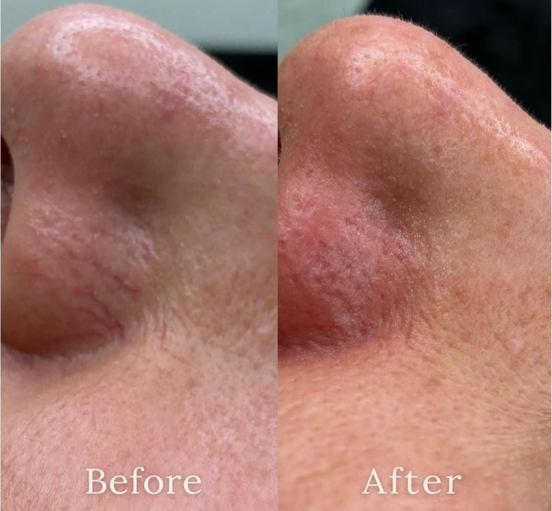 Before and after comparison of a nose with skin treatment