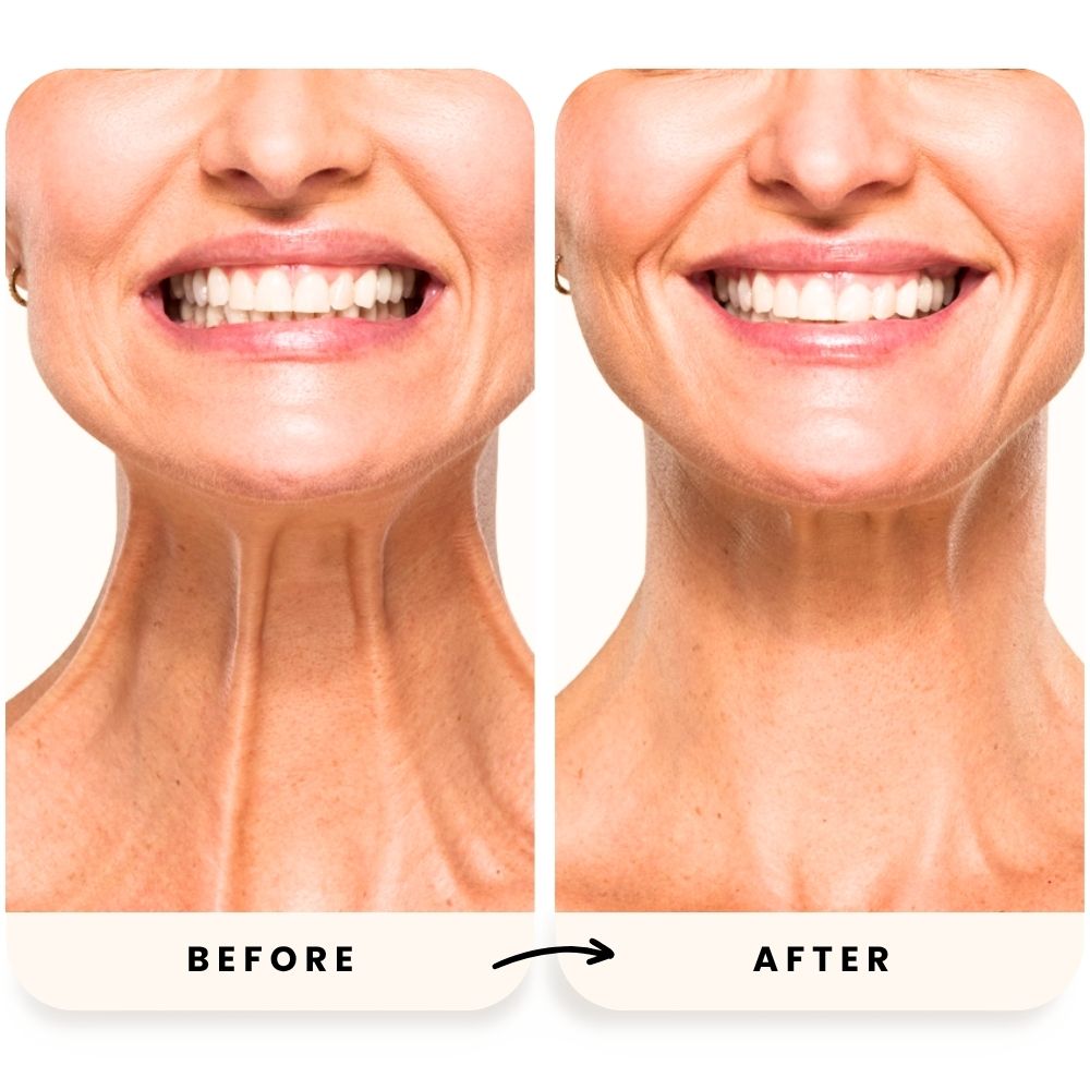 Medical aesthetics before and after results at Injections and Co Sarasota medical spa