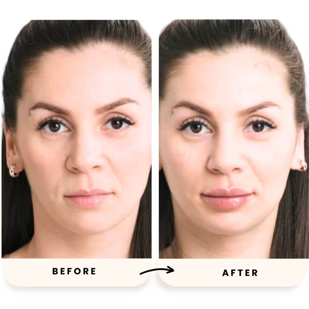 Before and after images showcasing results from Exploring Botox Options in Sarasota.