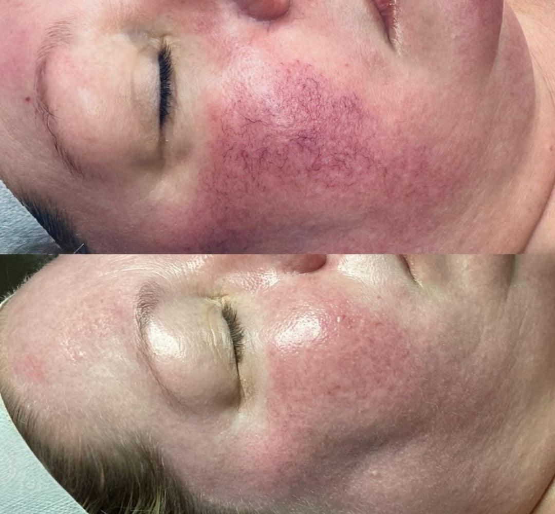 Before and after comparison of a person's face with visible skin conditions.