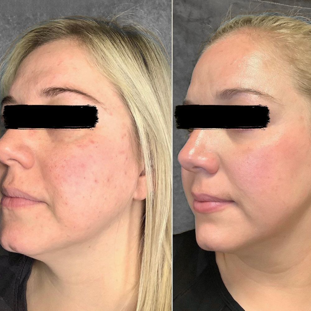Mobile view of skin transformation showing reduced redness and acne after Aerolase laser treatment at Injections & Co. in Sarasota