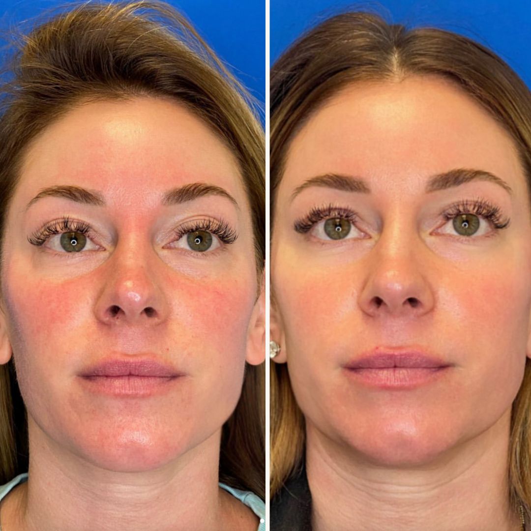 Side-by-side image of female patient before and after Aerolase laser therapy in Sarasota, showing clear improvement in redness and rosacea symptoms.